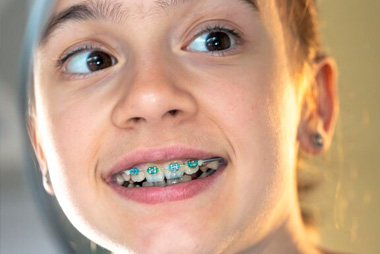 Braces Colors: Tips for Choosing the Perfect Look