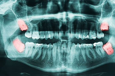 Why Should You Have Your Wisdom Teeth Removed in Middle Age or Later?